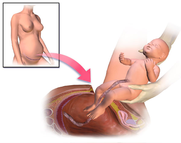 Caesarian Section