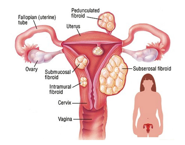 Ovarian Cyst
